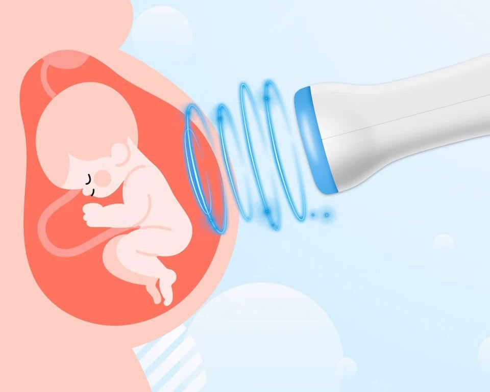 ECOGRAFIE DE CASĂ DOPPLER FETAL (OBSERVATORUL BEBELILOR) PENTRU FEMEILE ÎN CARTEA